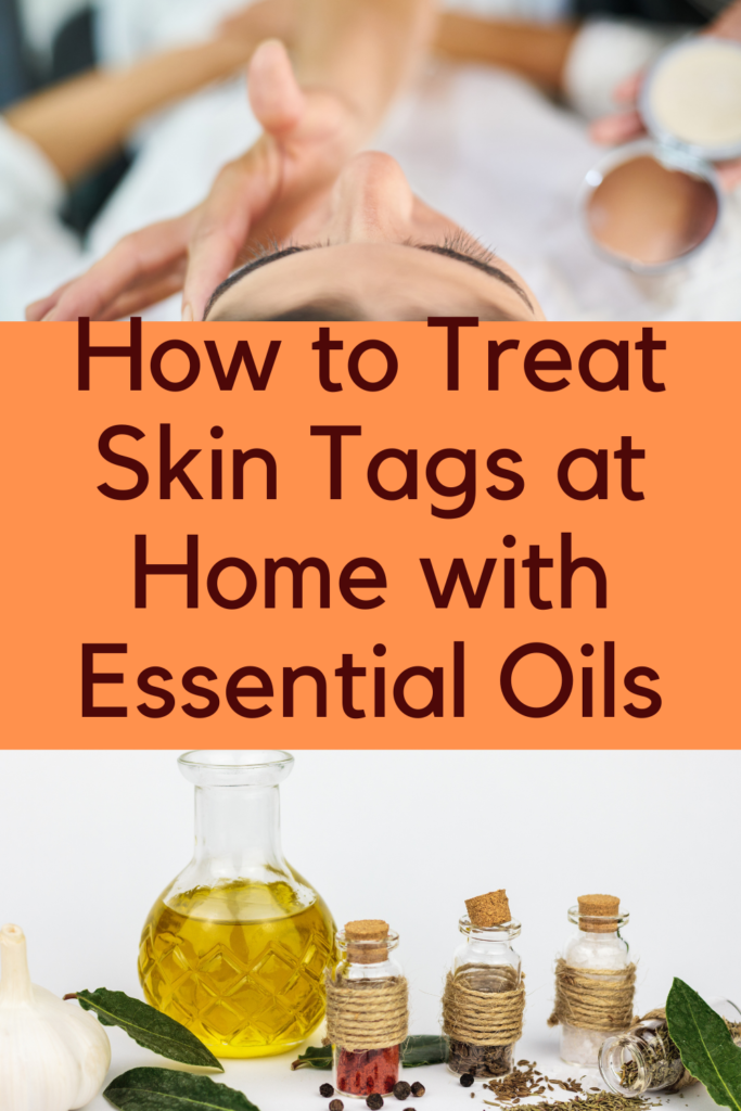 Essential Oils for Skin Tags
